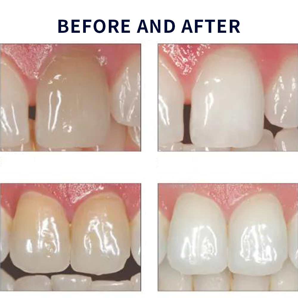 Отбеливающий набор opalution 2 – обзор и цена Teeth Whitening Before And After