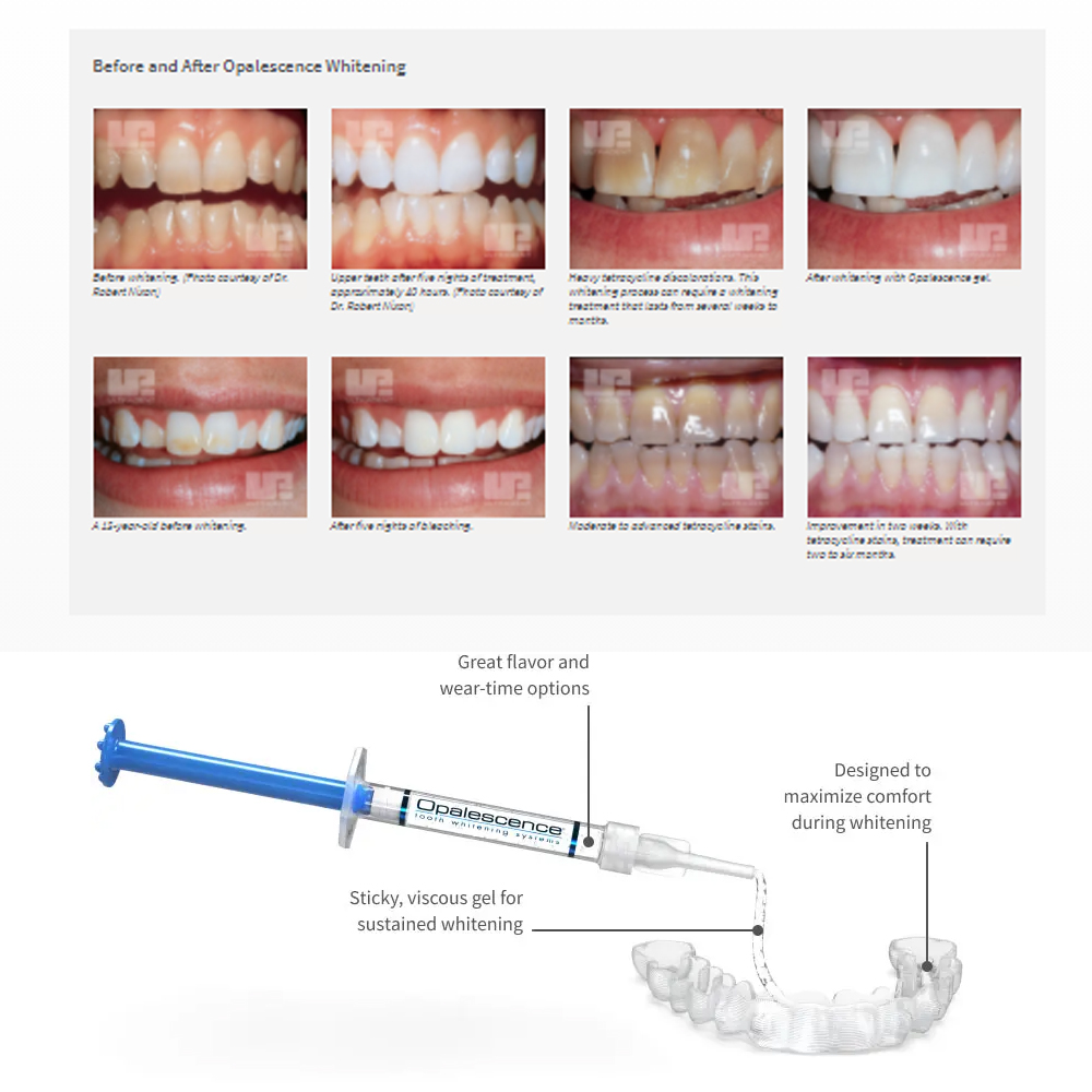 Отбеливающий набор opalution 2 – обзор и цена Teeth Whitening Before And After
