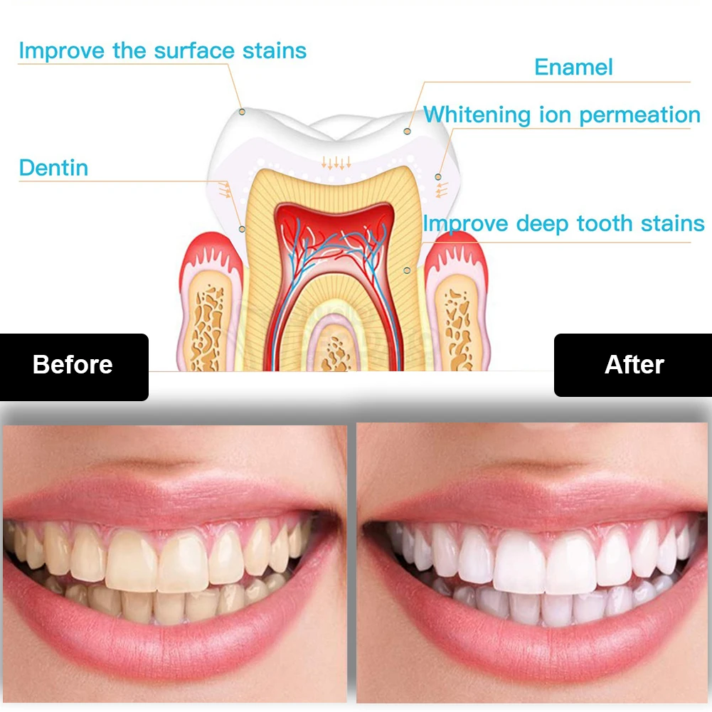 Набор для отбеливания зубов, м – обзор и цена Teeth Whitening Gel Peroxide