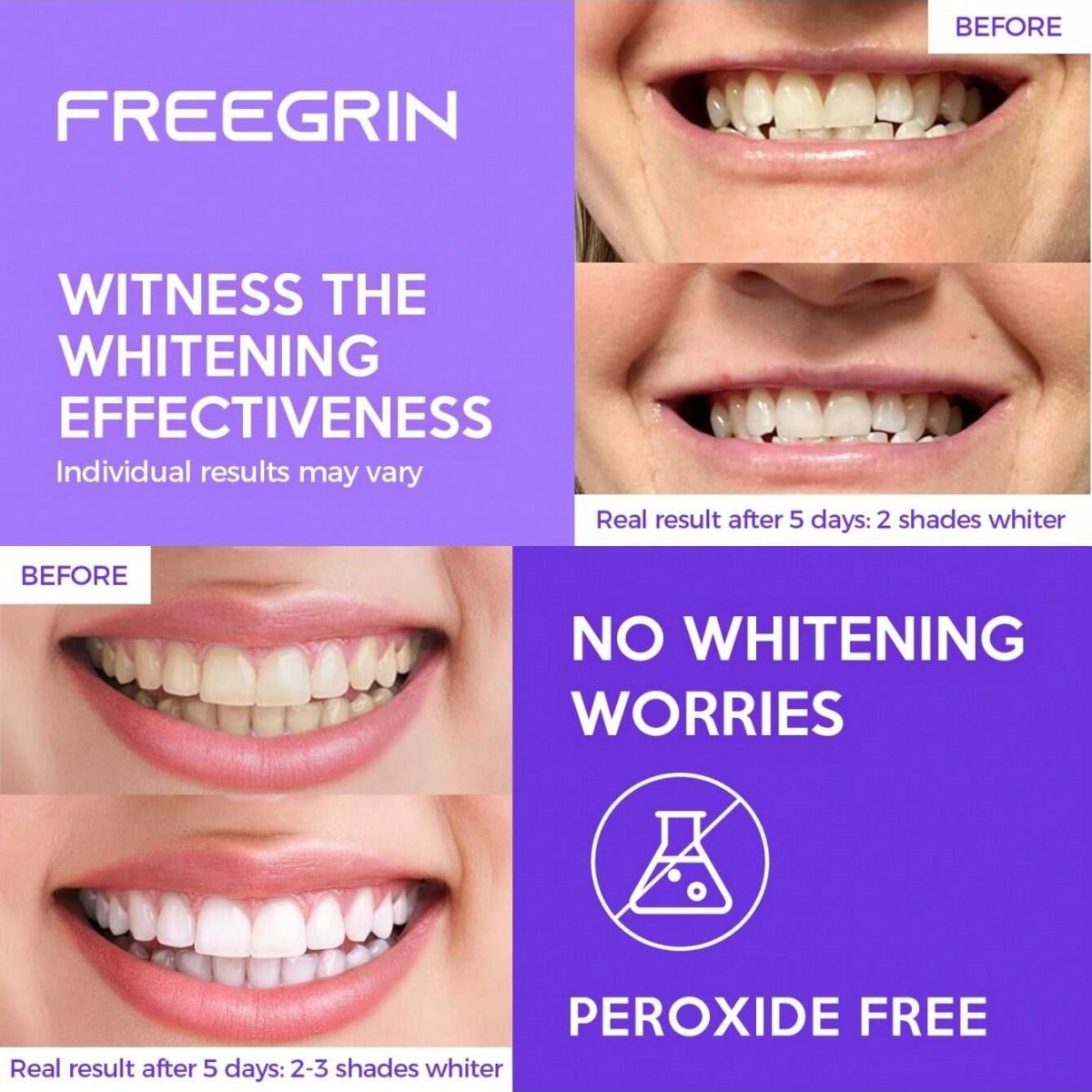 Роскошные отбеливающие наклейк – обзор и цена Teeth Whitening Before And After